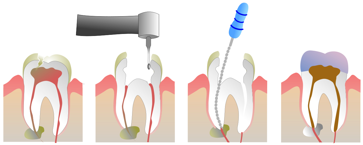 1250px-Root_Canal_Illustration_Molar.svg