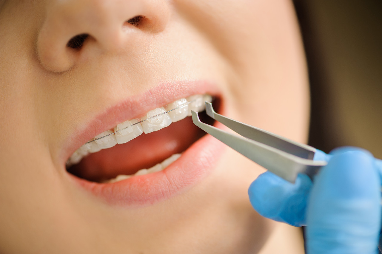 close-up-ceramic-brackets-dental-clinic