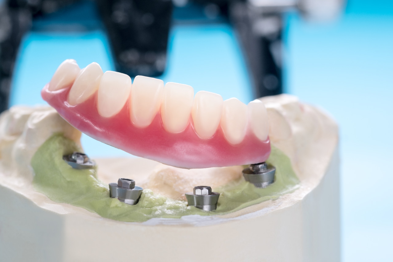 closeup-dental-implants-supported-overdenture-blue-background-screw-retained-implant-restorations