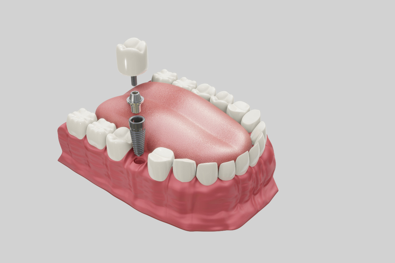 dental-implants-treatment-procedure-medically-accurate-3d-illustration-dentures-concept-1